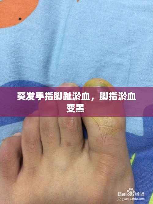 突发手指脚趾淤血,脚指淤血变黑